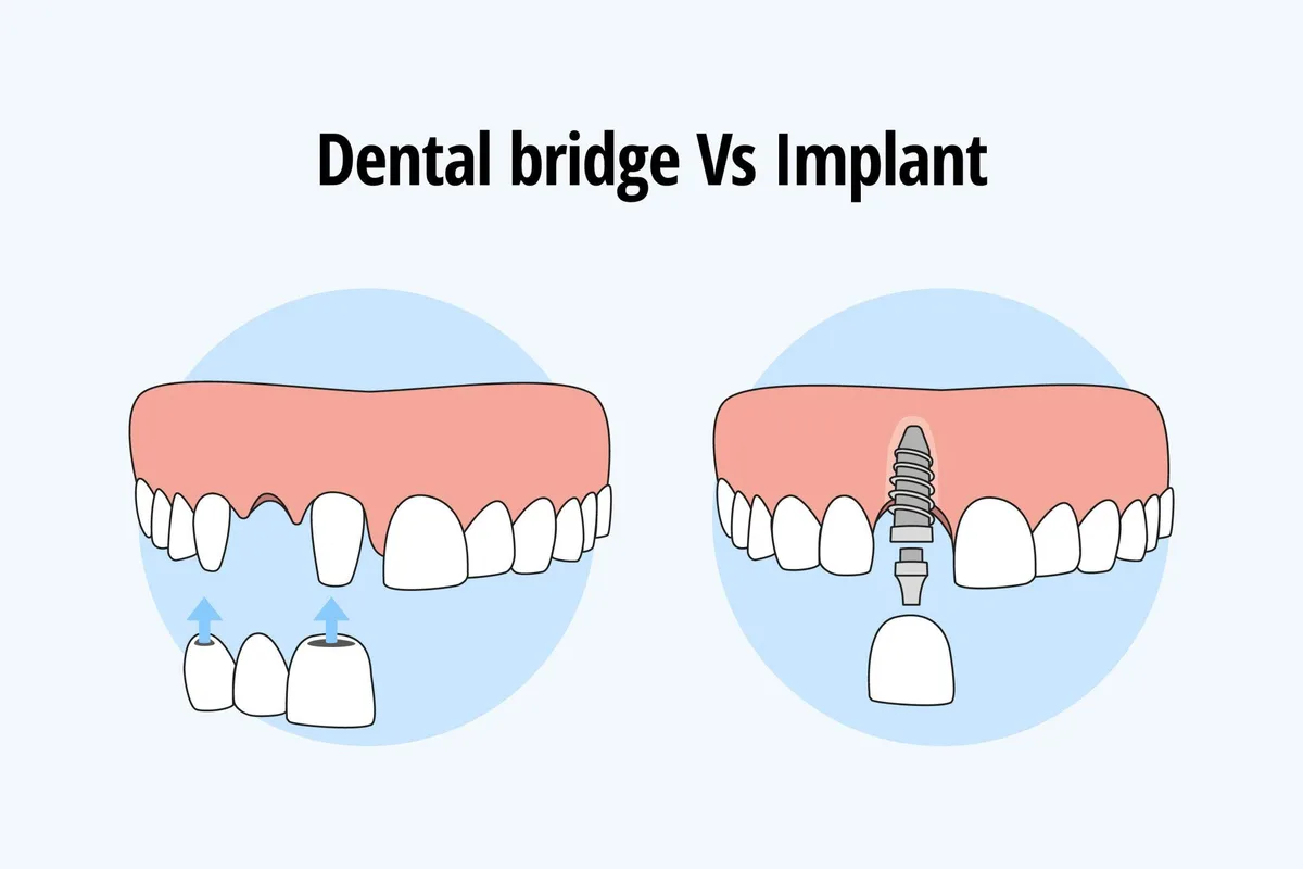Implants or Bridge: Which Is the Best Choice?